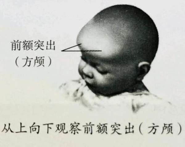 方颅宝宝图片佝偻病图片