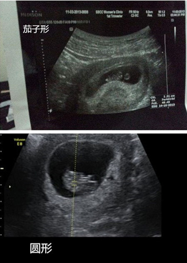 孕囊圆形和椭圆形图片图片