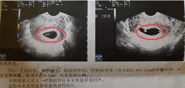 怀孕60天男孩孕囊图片图片