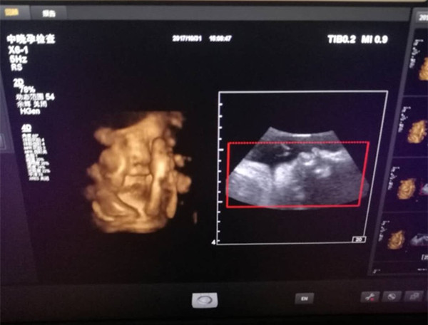 怀孕男宝阴囊图片图片