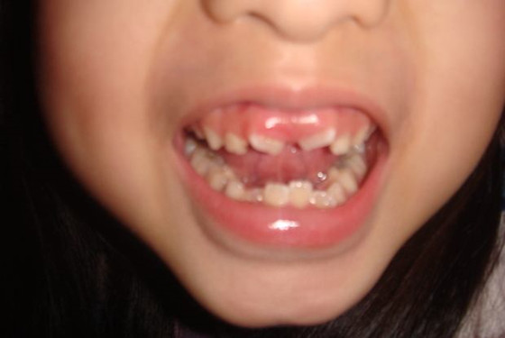 儿童牙齿歪斜图片图片